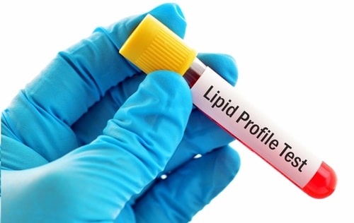 Lipid Profile Test